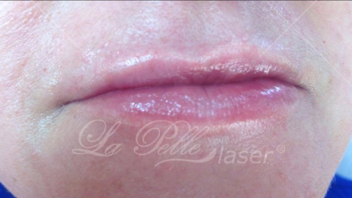 Kwas hialuronowy (Wypełnianie zmarszczek Powiększanie ust) - Instytut Kosmetyczny