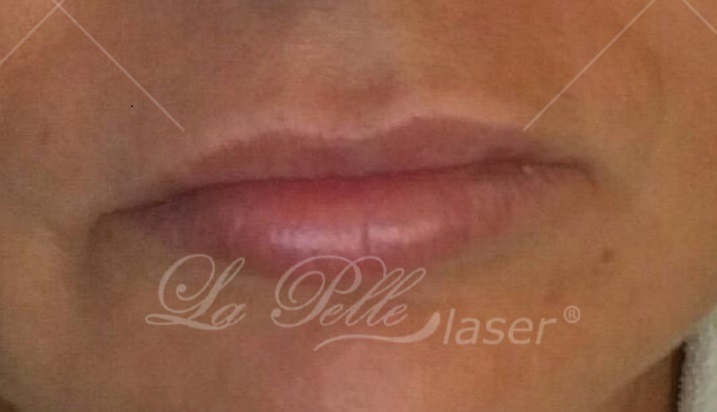 Kwas hialuronowy (Wypełnianie zmarszczek Powiększanie ust) - Instytut Kosmetyczny